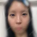 目頭切開 / 小鼻縮小（切開） / 鼻尖形成（非切開） アネシス美容クリニック DAY 35 サムネイル用