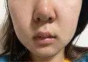 エレクトロポレーション / 光治療（フォトフェイシャルなど） 若倉診療所 DAY 6 サムネイル用