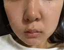 エレクトロポレーション / 光治療（フォトフェイシャルなど） 若倉診療所 DAY 7 サムネイル用