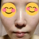 美肌レーザー みやた形成外科・皮ふクリニック AFTER サムネイル用