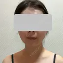 糸リフト / 脂肪吸引（顔） / 脂肪吸引（二の腕） / 脂肪注入（額） 脂肪吸引ラボトウキョウ AFTER サムネイル用