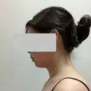 糸リフト / 脂肪吸引（顔） / 脂肪吸引（二の腕） / 脂肪注入（額） 脂肪吸引ラボトウキョウ DAY 25 サムネイル用
