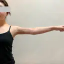 糸リフト / 脂肪吸引（顔） / 脂肪吸引（二の腕） / 脂肪注入（額） 脂肪吸引ラボトウキョウ DAY 25 サムネイル用