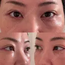 クマ治療 EMMO FACE CLINIC 東京三田院 DAY 7 サムネイル用