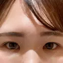 クマ治療 TCB東京中央美容外科 前橋院 DAY 0 サムネイル用