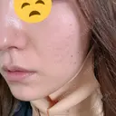 糸リフト 目白ホワイトクリニック DAY 0 サムネイル用