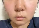エレクトロポレーション / 光治療（フォトフェイシャルなど） 若倉診療所 DAY 8 サムネイル用