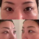 クマ治療 EMMO FACE CLINIC 東京三田院 DAY 8 サムネイル用