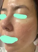 その他（肌） / ダーマペン スキンリファインクリニック銀座 DAY 2 サムネイル用