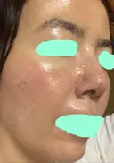 その他（肌） / ダーマペン スキンリファインクリニック銀座 DAY 2 サムネイル用