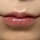 ヒアルロン酸注入（唇） AZ BEAUTY CLINIC DAY 0 サムネイル用