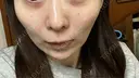 美肌レーザー まゆりなclinic 名古屋栄 DAY 2 サムネイル用