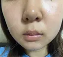 エレクトロポレーション / 光治療（フォトフェイシャルなど） 若倉診療所 DAY 9 サムネイル用