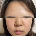 エレクトロポレーション / 光治療（フォトフェイシャルなど） 若倉診療所 DAY 9 サムネイル用
