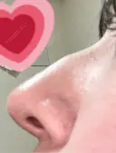 鼻尖形成（切開） / 小鼻縮小（切開） / 軟骨移植 / 鼻尖縮小 東京シンデレラ美容外科 新宿院 DAY 90 サムネイル用