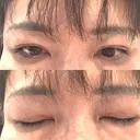 二重埋没 / 目元修正 BELINDA CLINIC（ベリンダクリニック）岡山院 DAY 34 サムネイル用