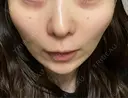 美肌レーザー まゆりなclinic 名古屋栄 DAY 3 サムネイル用