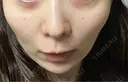 美肌レーザー まゆりなclinic 名古屋栄 DAY 4 サムネイル用