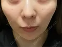 美肌レーザー まゆりなclinic 名古屋栄 DAY 6 サムネイル用