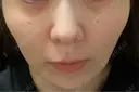 美肌レーザー まゆりなclinic 名古屋栄 DAY 8 サムネイル用