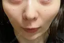 美肌レーザー まゆりなclinic 名古屋栄 DAY 9 サムネイル用