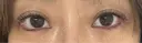 目頭切開 / タレ目形成・グラマラスライン（埋没） LOUIS CLINIC 二子玉川院【ルイクリニック】 DAY 1 サムネイル用