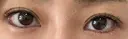目頭切開 / タレ目形成・グラマラスライン（埋没） LOUIS CLINIC 二子玉川院【ルイクリニック】 AFTER サムネイル用