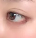 目尻切開 / 目尻靭帯移動 FROM B整形外科 (旧バウム整形外科) DAY 31 サムネイル用