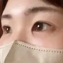 クマ治療 TCB東京中央美容外科 前橋院 DAY 2 サムネイル用