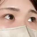 クマ治療 TCB東京中央美容外科 前橋院 DAY 2 サムネイル用
