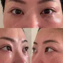 クマ治療 EMMO FACE CLINIC 東京三田院 DAY 10 サムネイル用