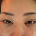 クマ治療 EMMO FACE CLINIC 東京三田院 DAY 9 サムネイル用