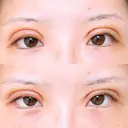 二重切開 アネシス美容クリニック DAY 3 サムネイル用