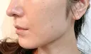 糸リフト 目白ホワイトクリニック DAY 4 サムネイル用