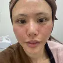 水光注射（ハリ・美肌） / リジュラン 湘南美容クリニック 池袋西口院 AFTER サムネイル用