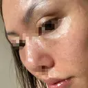 水光注射（ハリ・美肌） / リジュラン 湘南美容クリニック 池袋西口院 DAY 0 サムネイル用