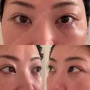 クマ治療 EMMO FACE CLINIC 東京三田院 DAY 11 サムネイル用