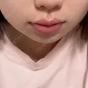ボトックス（エラ・小顔） / ボトックス（口角） TCB東京中央美容外科 つくば院 DAY 2 サムネイル用