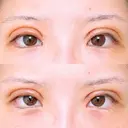 二重切開 アネシス美容クリニック DAY 4 サムネイル用