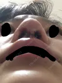 鼻尖形成（切開） 三輪皮フ科形成外科 DAY 1 サムネイル用