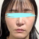 小鼻縮小（切開） / 鼻翼基部形成（貴族手術） 新宿ラクル美容外科クリニック 新宿院 AFTER サムネイル用