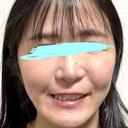 小鼻縮小（切開） / 鼻翼基部形成（貴族手術） 新宿ラクル美容外科クリニック 新宿院 DAY 93 サムネイル用