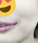 ボトックス（口角） / ワキ汗治療（ボトックス） DMTC CLINIC 日本橋院 AFTER サムネイル用