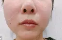 脂肪溶解注射（顔） Nクリニック伏見 DAY 0 サムネイル用