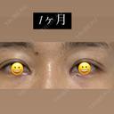 目頭切開 / 目尻切開 / 自然癒着法 LUHO（ルホ）美容外科 DAY 37 サムネイル用