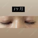 目頭切開 / 目尻切開 / 自然癒着法 LUHO（ルホ）美容外科 DAY 37 サムネイル用