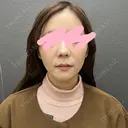 小鼻縮小（切開） 渋谷の森クリニック AFTER サムネイル用