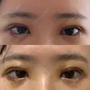 二重切開 水の森美容クリニック 横浜院 DAY 3 サムネイル用