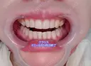 矯正（マウスピース） オーラルビューティークリニック クラリス審美歯科・矯正歯科 DAY 251 サムネイル用