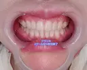 矯正（マウスピース） オーラルビューティークリニック クラリス審美歯科・矯正歯科 AFTER サムネイル用